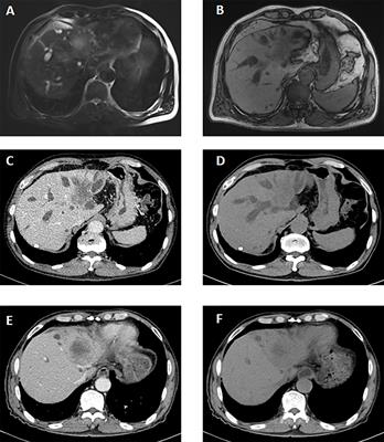 Treatment and Survival Patterns of Primary Adenosquamous Carcinoma of the Liver: A Retrospective Analysis